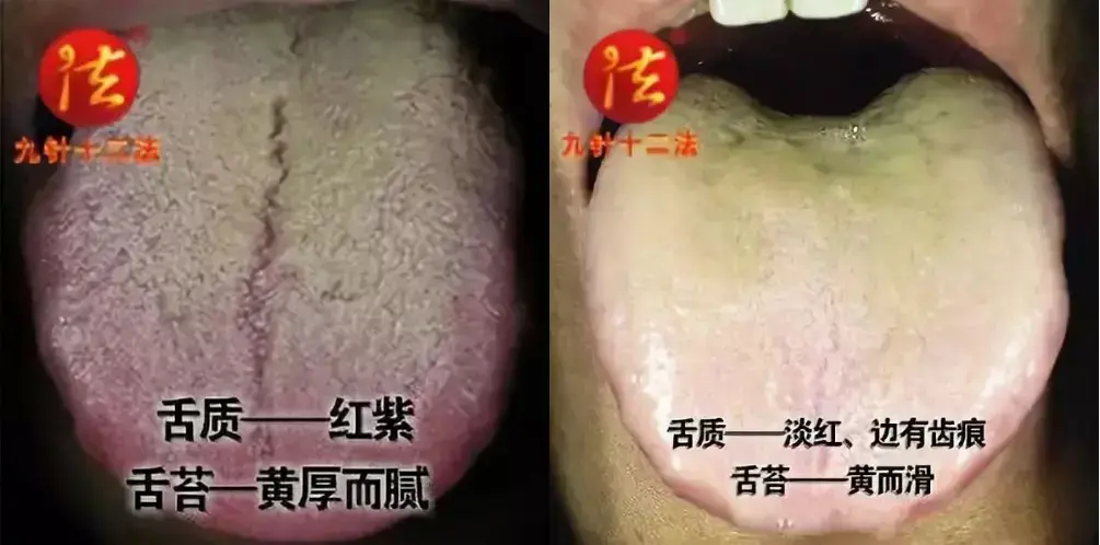 赤舌哪里多|上颌骨裂痕多怎么办？三种舌象，快来对比一下你是哪一种？