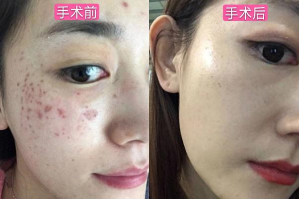 皮秒祛斑的费用一般是多少 皮秒祛斑的危害与效果