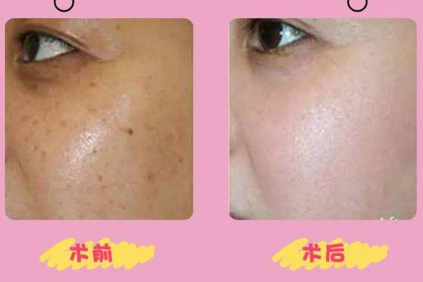 皮秒祛斑要间隔多长时间做一次 皮秒祛斑要敷麻药吗