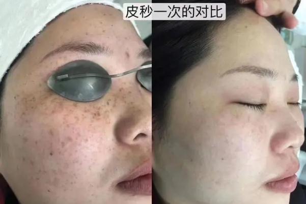 皮秒祛斑的费用一般是多少 皮秒祛斑的危害与效果 皮秒祛斑的费用一般是多少 皮秒祛斑的危害与效果