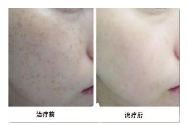 皮秒祛斑的费用一般是多少 皮秒祛斑的危害与效果 皮秒祛斑的费用一般是多少 皮秒祛斑的危害与效果