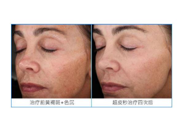 皮秒祛斑要间隔多长时间做一次 皮秒祛斑要敷麻药吗