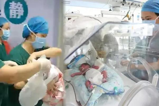 24岁产妇早产1女4男5胞胎 早产是指多少周