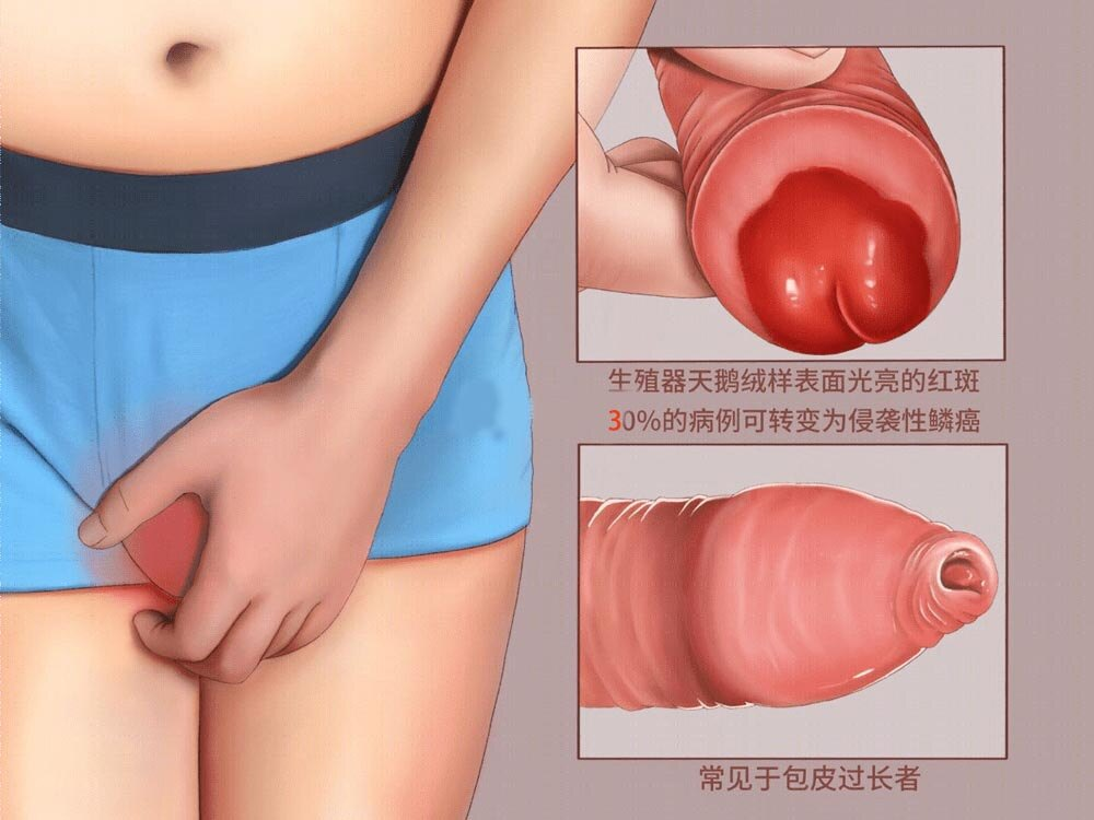 陈善闻主任：龟头皮肤病有哪些？我们把它分成6大类32种