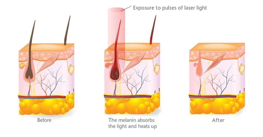 “如何给妹妹脱毛，男友才不会感到光阴似箭？”