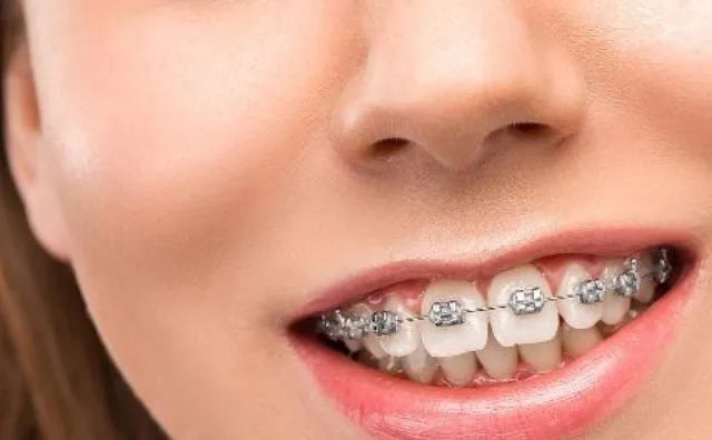 有牙周炎矫正是传统好还是隐形的好，隐形牙齿矫正大概要多少钱